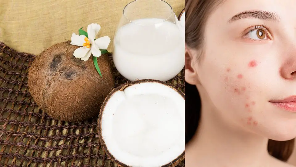 can-coconut-milk-cause-acne-coconut-friends